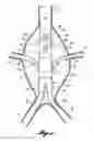 Fig. 02 - DEVICE FOR REPAIRING ANEURYSM WITHIN MULTI-BRANCH VESSEL