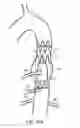 Fig. 34 - Method for aortic branched vessel repair