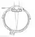Fig. 01 - Intraocular lens system with folding features