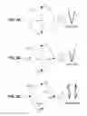 Fig. 04 - Intraocular lens system with folding features