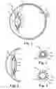 Fig. 02 - HAPTIC FOR ACCOMMODATING INTRAOCULAR LENS
