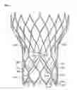 Fig. 01 - Leaflet-cuff attachments for prosthetic heart valve