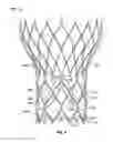 Fig. 07 - Leaflet-cuff attachments for prosthetic heart valve