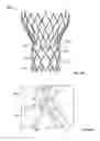 Fig. 08 - Leaflet-cuff attachments for prosthetic heart valve