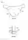 Fig. 10 - Leaflet-cuff attachments for prosthetic heart valve