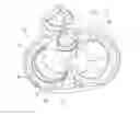 Fig. 03 - Mitral valve treatment techniques