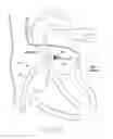 Fig. 31 - Implantable device and delivery system for reshaping a heart valve annulus