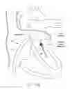 Fig. 32 - Implantable device and delivery system for reshaping a heart valve annulus