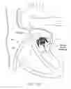 Fig. 33 - Implantable device and delivery system for reshaping a heart valve annulus