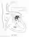 Fig. 34 - Implantable device and delivery system for reshaping a heart valve annulus