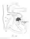 Fig. 35 - Implantable device and delivery system for reshaping a heart valve annulus