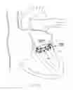 Fig. 43 - Implantable device and delivery system for reshaping a heart valve annulus