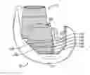Fig. 01 - Void filling joint prosthesis and associated instruments