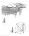Fig. 05 - Femoral heads, mobile inserts, acetabular components, and modular junctions for orthopedic implants and methods of using femoral heads, mobile insets, acetabular components, and modular junctions for orthopedic implants