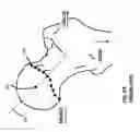 Fig. 09 - Femoral heads, mobile inserts, acetabular components, and modular junctions for orthopedic implants and methods of using femoral heads, mobile insets, acetabular components, and modular junctions for orthopedic implants