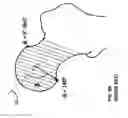 Fig. 10 - Femoral heads, mobile inserts, acetabular components, and modular junctions for orthopedic implants and methods of using femoral heads, mobile insets, acetabular components, and modular junctions for orthopedic implants