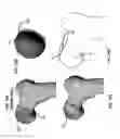 Fig. 19 - Femoral heads, mobile inserts, acetabular components, and modular junctions for orthopedic implants and methods of using femoral heads, mobile insets, acetabular components, and modular junctions for orthopedic implants