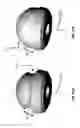 Fig. 53 - Femoral heads, mobile inserts, acetabular components, and modular junctions for orthopedic implants and methods of using femoral heads, mobile insets, acetabular components, and modular junctions for orthopedic implants