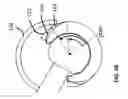 Fig. 64 - Femoral heads, mobile inserts, acetabular components, and modular junctions for orthopedic implants and methods of using femoral heads, mobile insets, acetabular components, and modular junctions for orthopedic implants