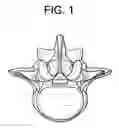Fig. 02 - Universal trial for lateral cages