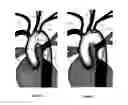 Fig. 03 - Apparatus and method for stabilization of procedural catheter in tortuous vessels