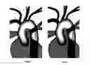 Fig. 04 - Apparatus and method for stabilization of procedural catheter in tortuous vessels