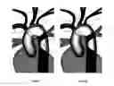 Fig. 09 - Apparatus and method for stabilization of procedural catheter in tortuous vessels