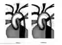 Fig. 11 - Apparatus and method for stabilization of procedural catheter in tortuous vessels