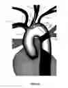 Fig. 12 - Apparatus and method for stabilization of procedural catheter in tortuous vessels