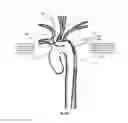 Fig. 15 - Apparatus and method for stabilization of procedural catheter in tortuous vessels