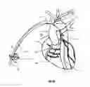 Fig. 27 - Apparatus and method for stabilization of procedural catheter in tortuous vessels
