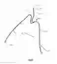 Fig. 28 - Apparatus and method for stabilization of procedural catheter in tortuous vessels