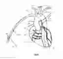 Fig. 31 - Apparatus and method for stabilization of procedural catheter in tortuous vessels