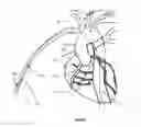 Fig. 32 - Apparatus and method for stabilization of procedural catheter in tortuous vessels