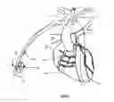 Fig. 33 - Apparatus and method for stabilization of procedural catheter in tortuous vessels