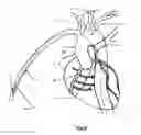 Fig. 35 - Apparatus and method for stabilization of procedural catheter in tortuous vessels