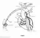 Fig. 37 - Apparatus and method for stabilization of procedural catheter in tortuous vessels