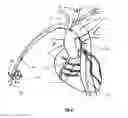 Fig. 41 - Apparatus and method for stabilization of procedural catheter in tortuous vessels