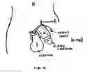 Fig. 05 - Elastic Pressure Device