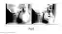 Fig. 09 - Adjuster for airway securing device and airway securing device