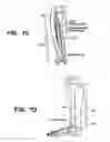 Fig. 04 - Implantable electroacupuncture system and method for treating dyslipidemia and obesity