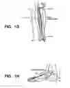 Fig. 06 - Implantable electroacupuncture system and method for treating dyslipidemia and obesity