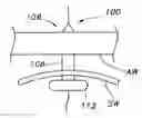 Fig. 01 - Dilation device for placing catheter tubes