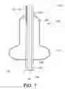 Fig. 02 - Dilation device for placing catheter tubes