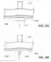 Fig. 04 - Dilation device for placing catheter tubes