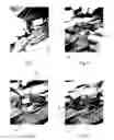 Fig. 02 - Method of sealing a durotomy