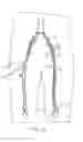 Fig. 29 - Systems and Methods for Removing Undesirable Material Within a Circulatory System