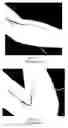 Fig. 09 - Intravenous splint cover and associated methods