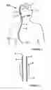 Fig. 02 - CATHETER AND SHUNT SYSTEM INCLUDING THE CATHETER