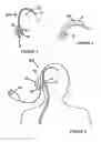 Fig. 03 - CATHETER AND SHUNT SYSTEM INCLUDING THE CATHETER